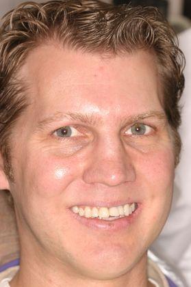Implants-and-Veneers-Before-Image